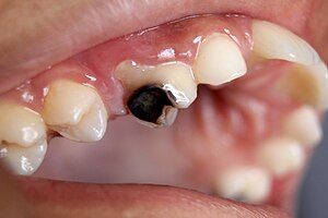 Dental_Caries_Cavity_2 Preventing tooth decay with Merrill Dentists