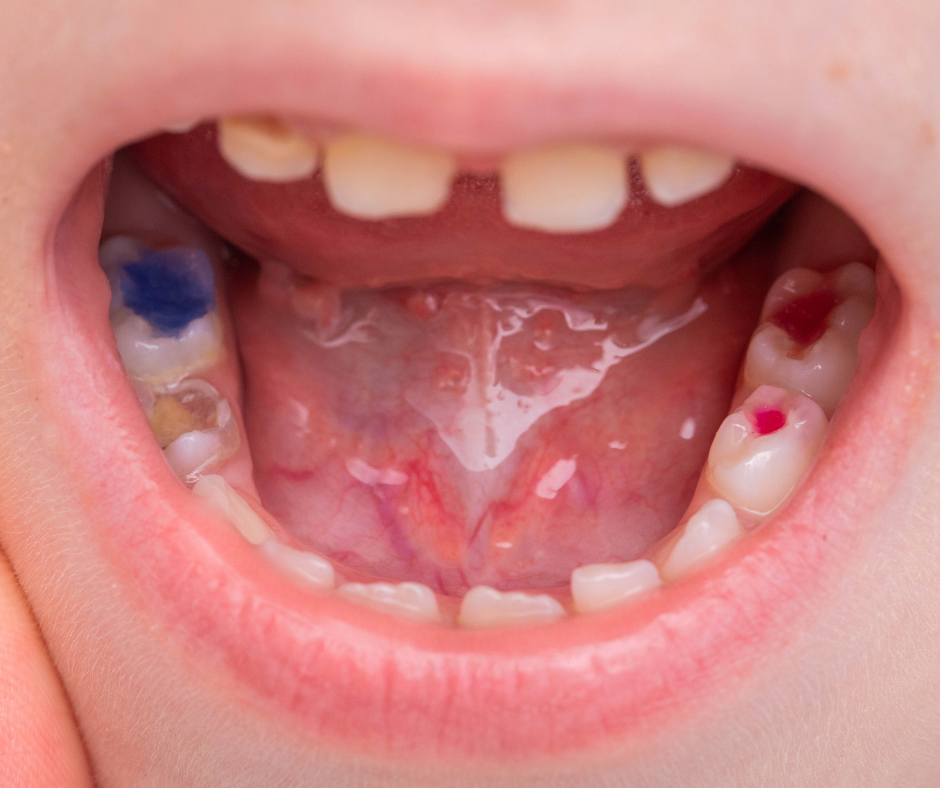 restorative (8) Preventing cavities with Merrill Dentists