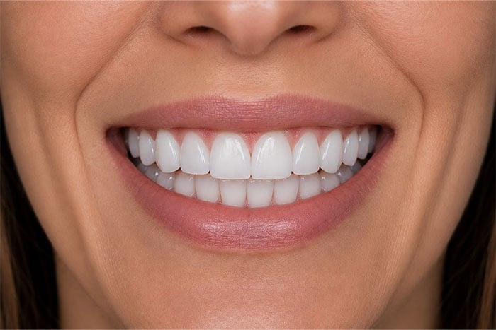 Porcelain-Veneers-Placement-Case-after