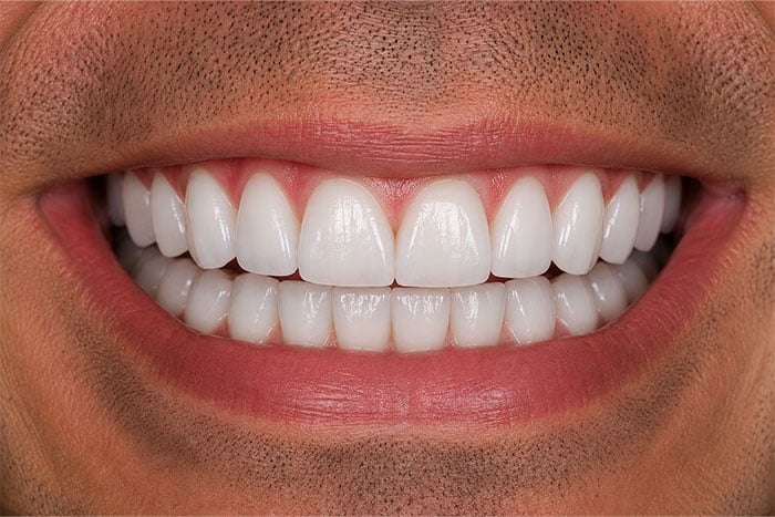 Smile-Makeover-after