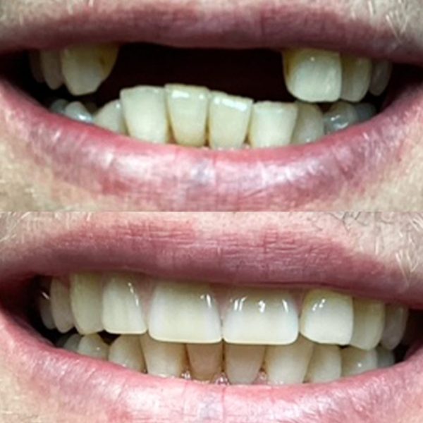 full mouth reconstruction